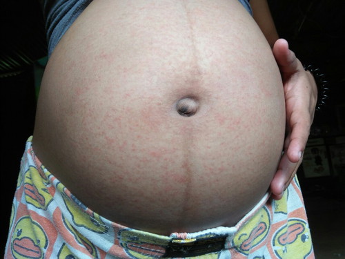 ตอนนี้อายุครรภ์36แล้วค่ะ