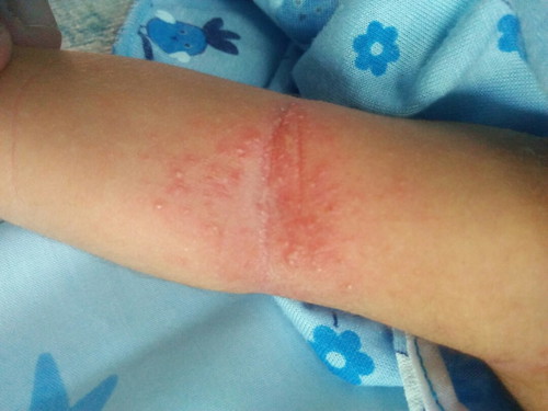 น้องมีเม็ดขึ้นแบบนี้ใช้อะไรหายค่ะ