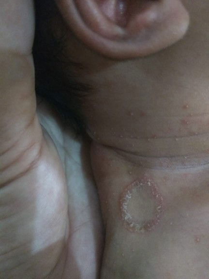 Apa Bener Ini Ringworm Alias Kurap?