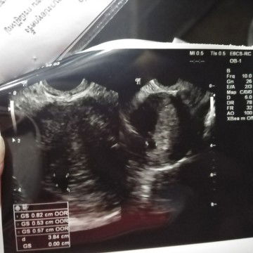 เจอแต่ถุงตั้งครรภ์แต่ยังไม่เจอเด็ก