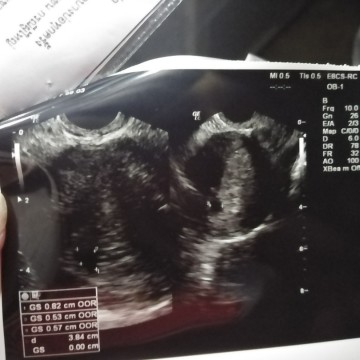 เจอแต่ถุงตั้งครรภ์แต่ยังไม่เจอเด็ก