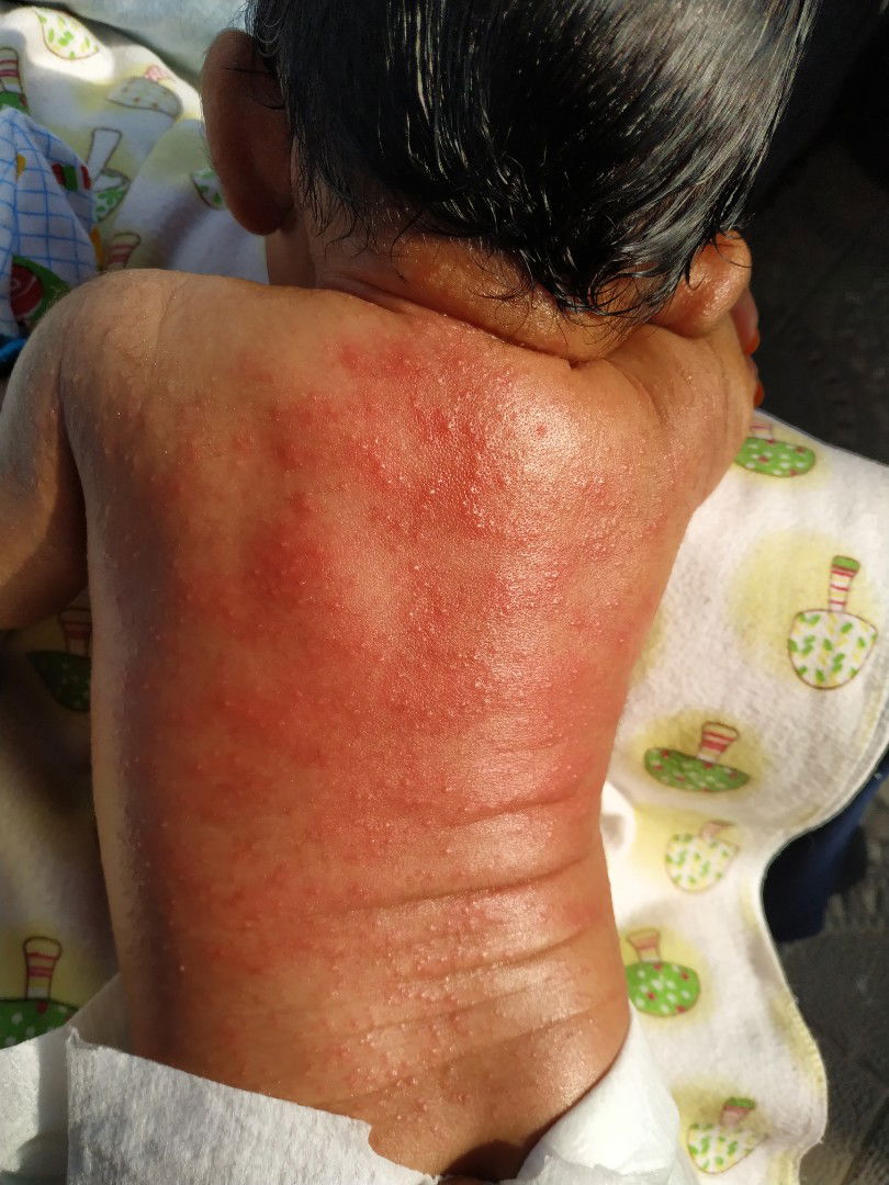 Bintil merah pada bayi