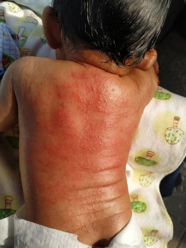 Bintil merah pada bayi