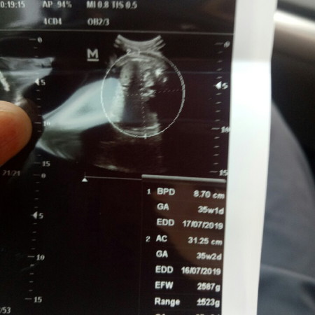 hasil usg beda dengan hpht