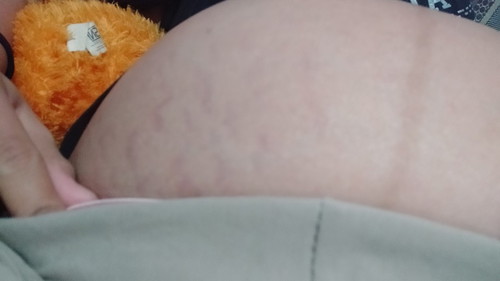 stretch mark