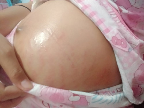 gatal dan bintik perut