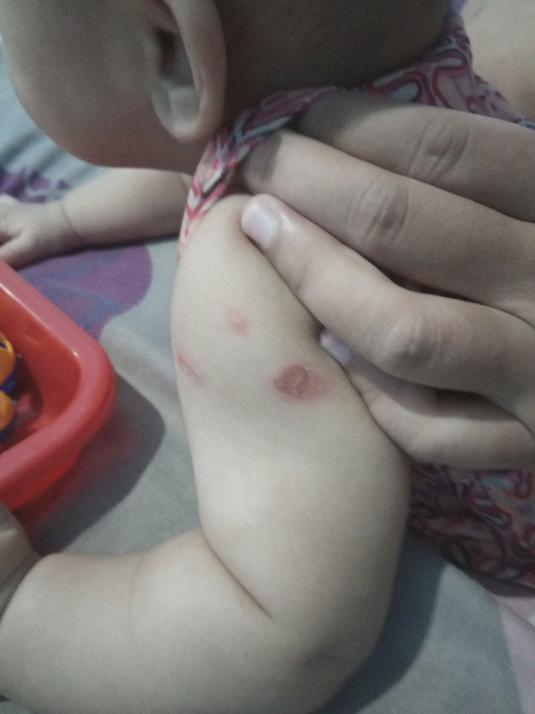 Merah bulat besar di kulit bayi