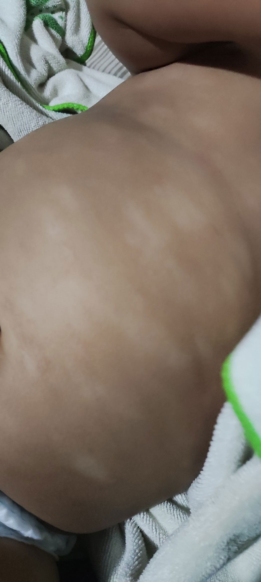 Bercak putih di perut anak 6 bulan