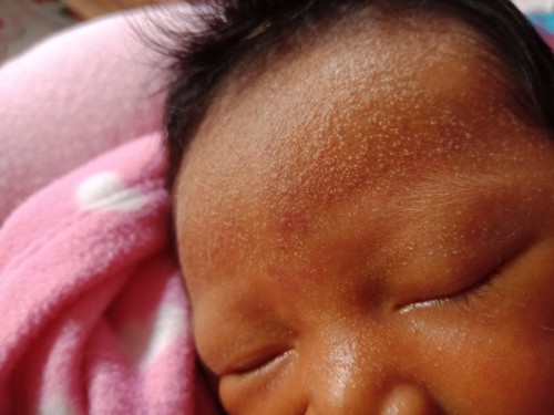 ผื่นแบบนี้จะหายเองไหม