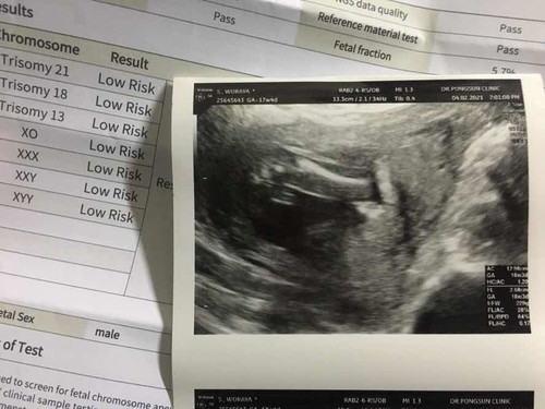 ผลตรวจดาวน์ออกแล้วแม่โล่งมากค่ะ