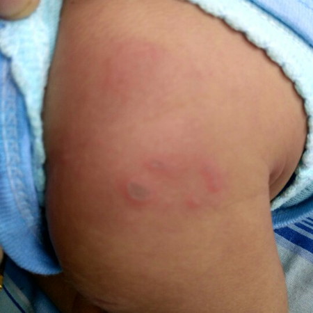 bentol merah