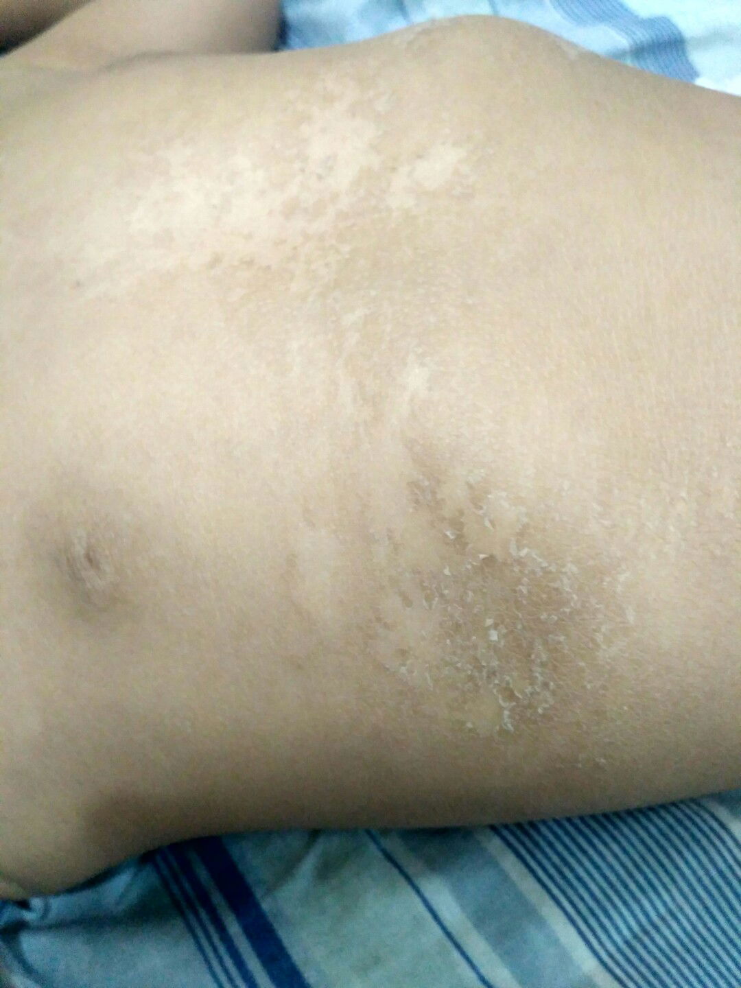 kulit kering dan mengelupas