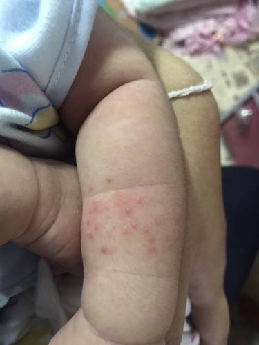 ผื่นขึ้นแขนลูกแบบนี้อันตรายมั้ยคะ