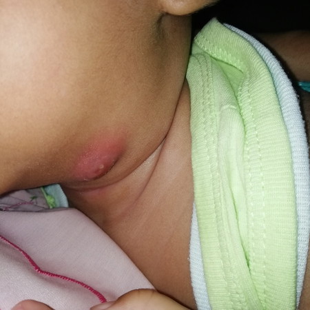 Bisul pada Bayi