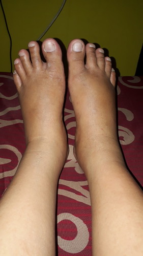 kaki bengkak