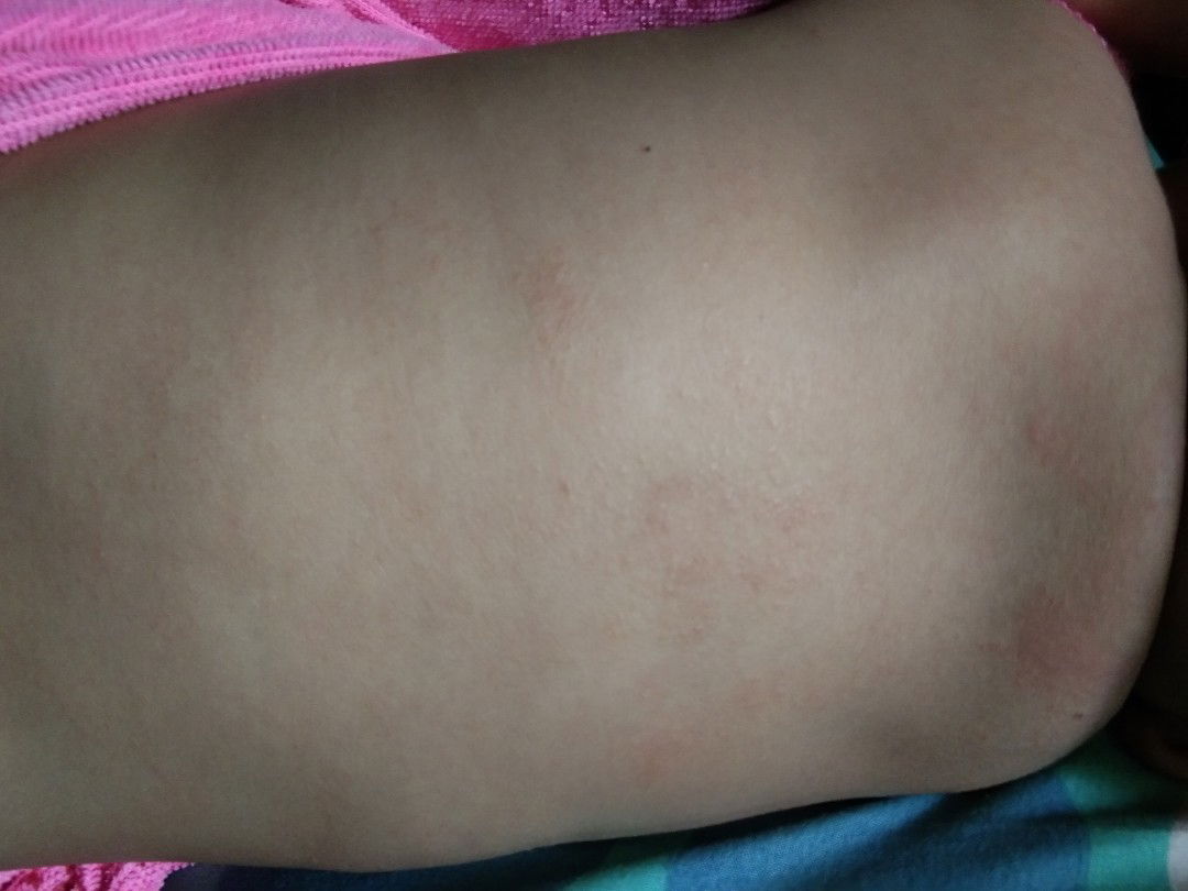 punggung bayi kemerahan
