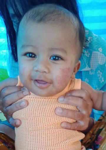 ผื่นแดงที่แก้ม