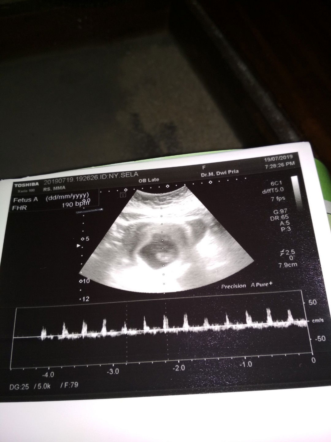 usia kandungan 8w4d udh ada detak jantungnya..