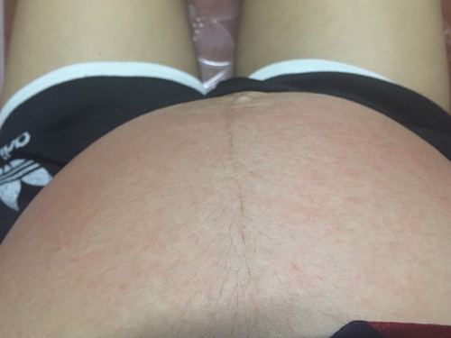 คันท้องมีตุ่มขึ้น