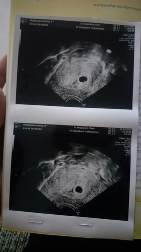 4w+6d ยังไม่เจอตัวอ่อน