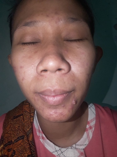 jerawat