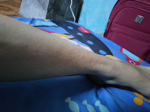 Hamil 32w kaki gatal2