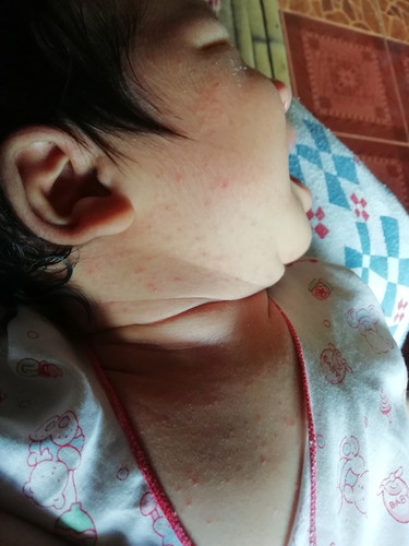 ลูกเป็นผื่นเยอะมากเกิดจากอะไรได้บ้างคะ