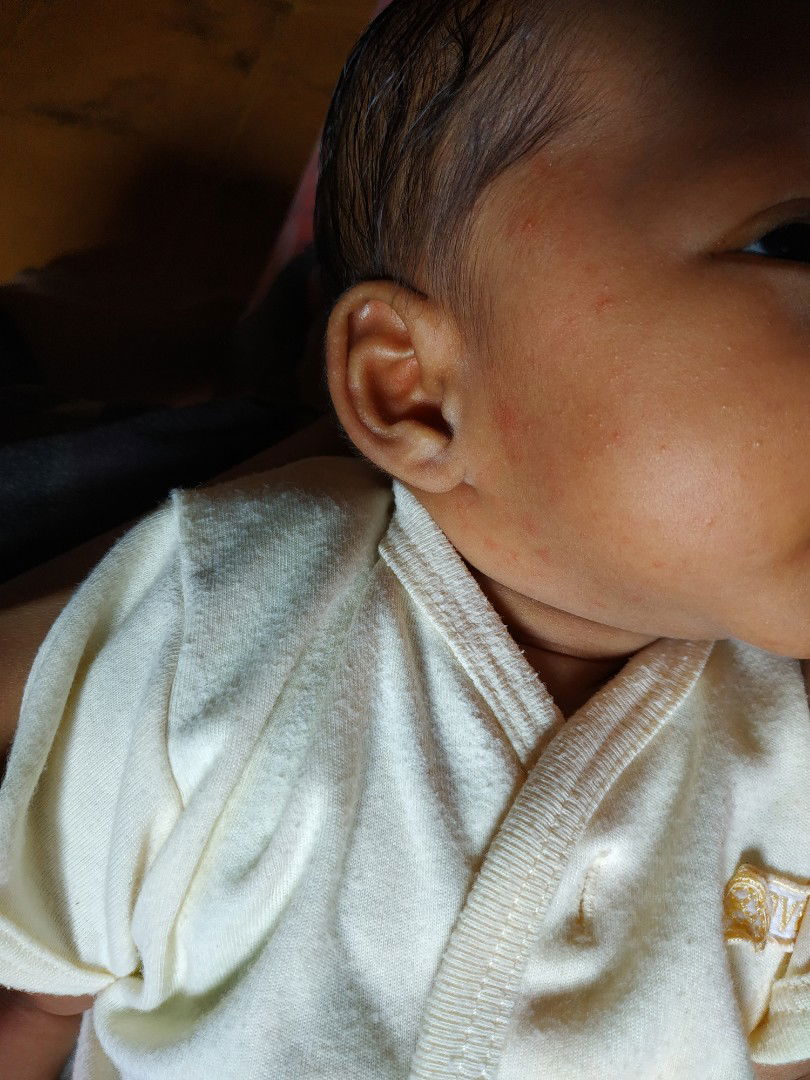 bintik merah pada wajah bayi