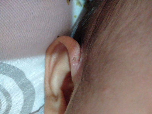 หูเป็นแผล