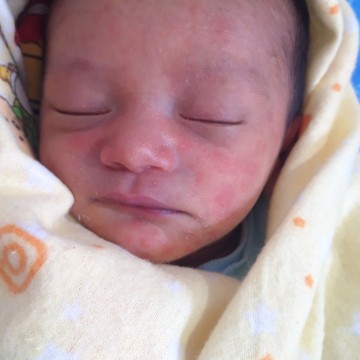 muka merah pada bayi