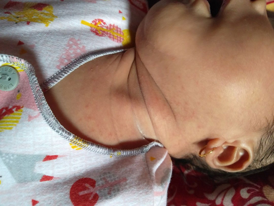 apakah ini biang keringat?