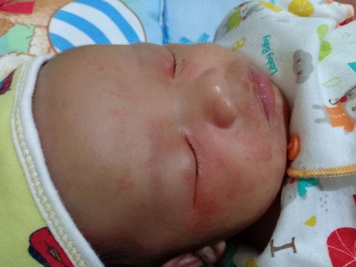 bintik merah pada pipi