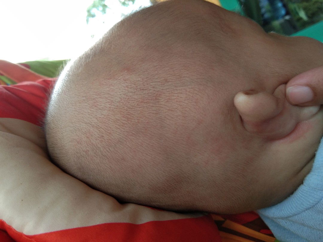 ruam apakah biang keringat?