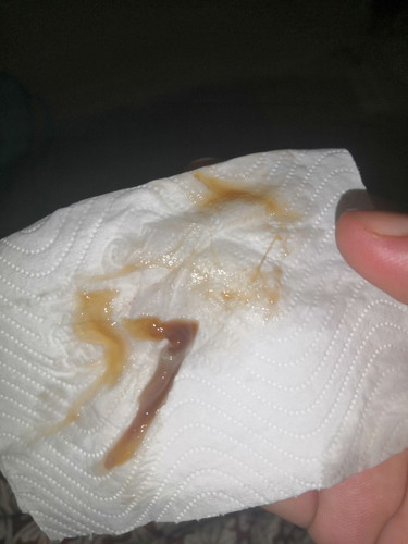 มูกสีแบบนี้ปากมดลูกเปิดแล้วใช่ไหมค่ะ