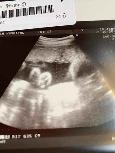 31 w ยังไม่รู้เพศเรยค่ะ ? ดูไม่เปนเรย