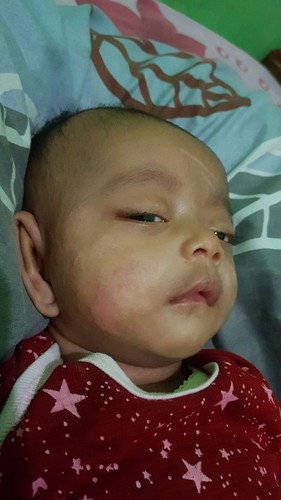 bekas ruam asi putih. apa obatnya??