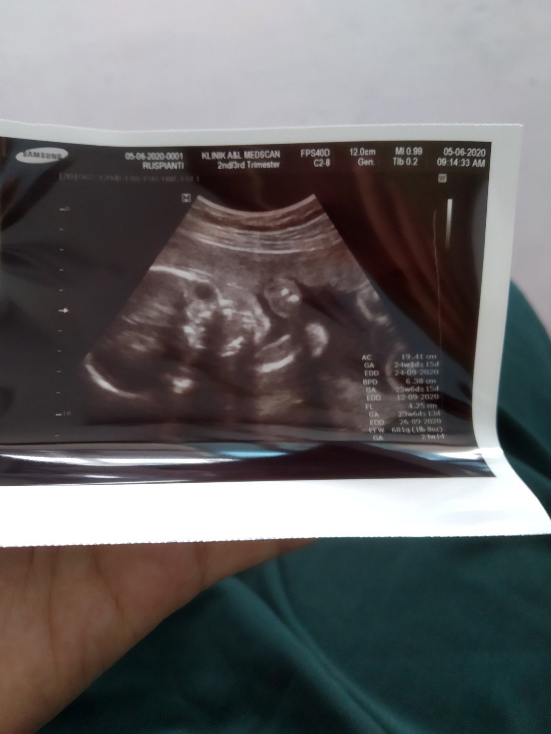 perbedaan ukuran BPD, AC, FL