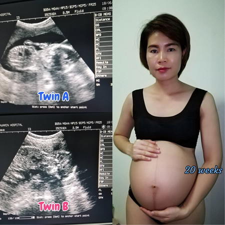 ครรภ์แฝด 20w มีอาการตัวเริ่มบวม เสี่ยงครรภ์เป็นพิษ