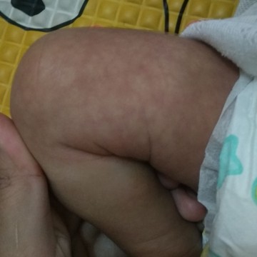 seperti ruam/bintik merah