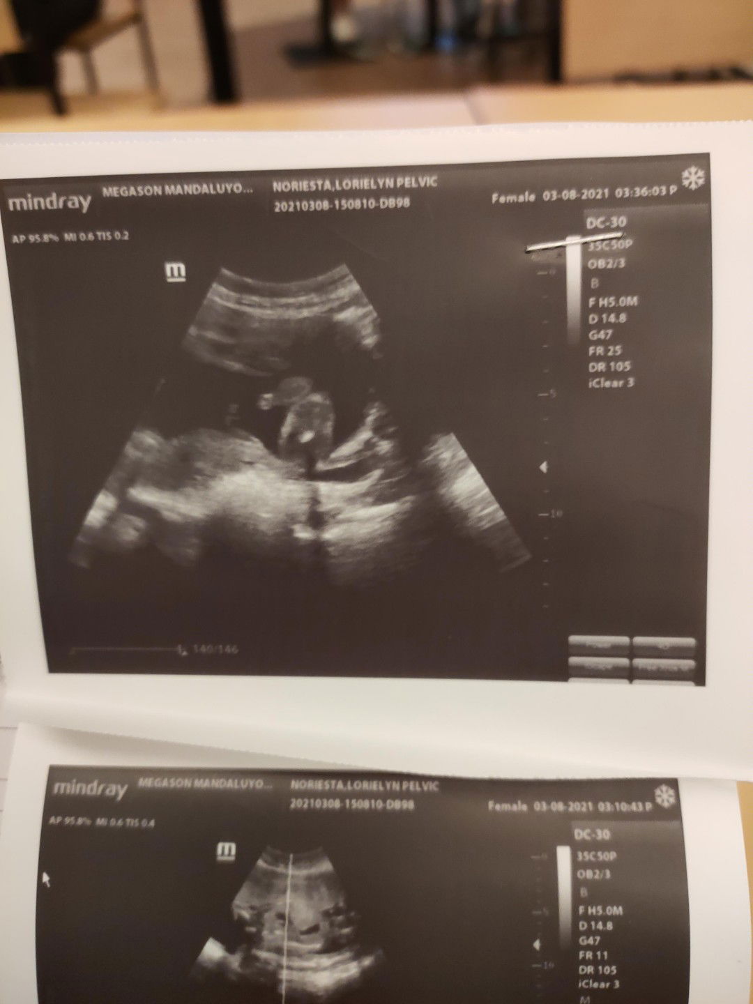 Hi mga Mommies Ask ko lang po kung sure na Baby Boy na po ito ? Thank you po sa lahat ng sasagot 😁