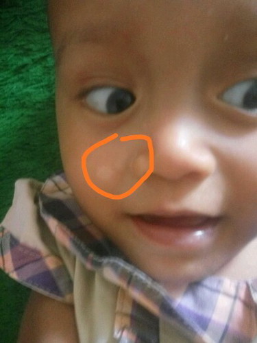 bercak putih di pipi