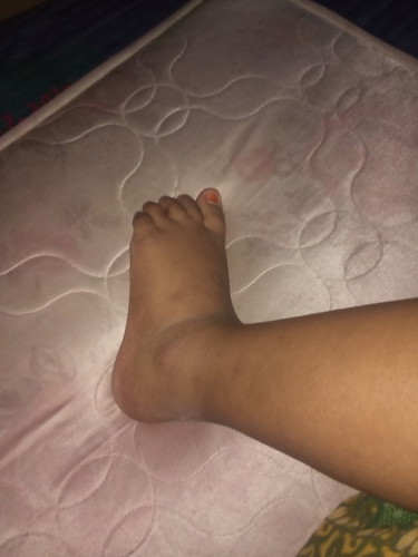 kaki bengkak