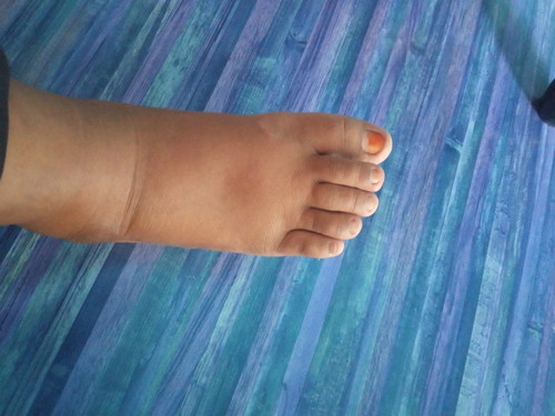 kaki bengkak