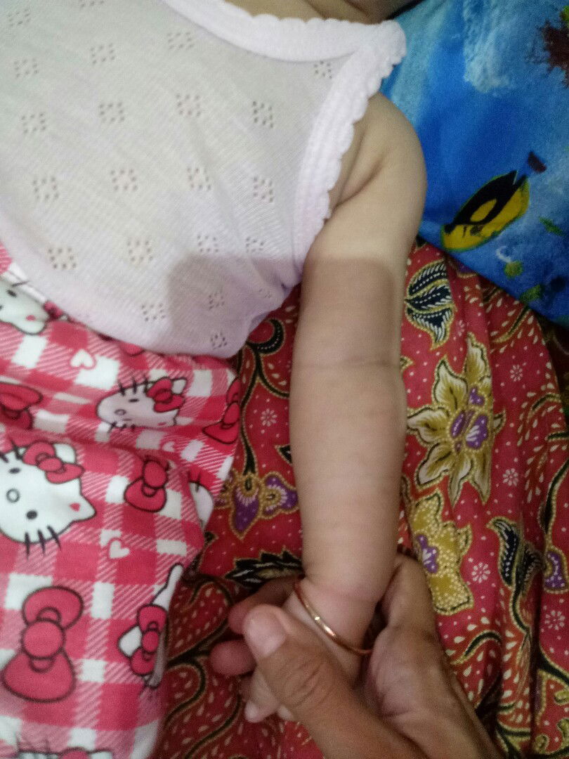 BEKAS GIGITAN NYAMUK