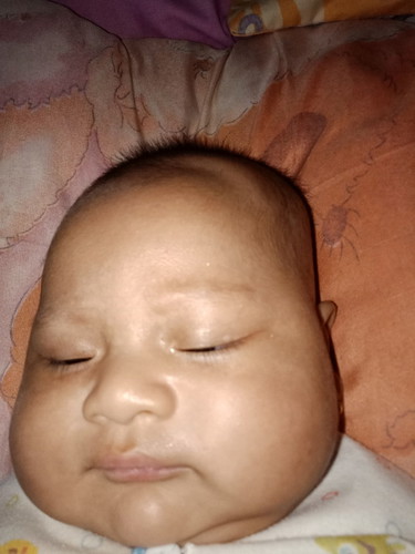 bercak putih di kulit bayi