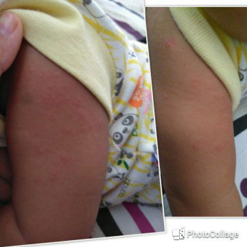 alergi atau biang keringet?