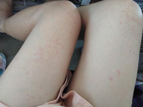 ผื่นขึ้นทั่วร่างกาย