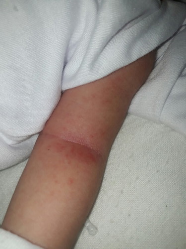 Rashes???