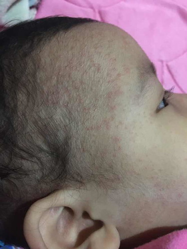 แม่แม่บ้านไหนเคยเจอแบบนี้มั่งมั้ยคะอยู่ดีดีลูกก็มีผื่นขึ้นเป็นมาจะหนึ่งอาทิตย์แล้วค่ะไม่มีใครไม่มีอาการใดใดค่ะทานข้าวได้เล่นได้ปกติแต่มีแค่ผื่นขึ้นศรีษะใบหน้าแล้วก็ตามข้อพับต่างๆ