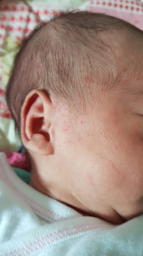 ตุ่มบนหน้าเด็ก